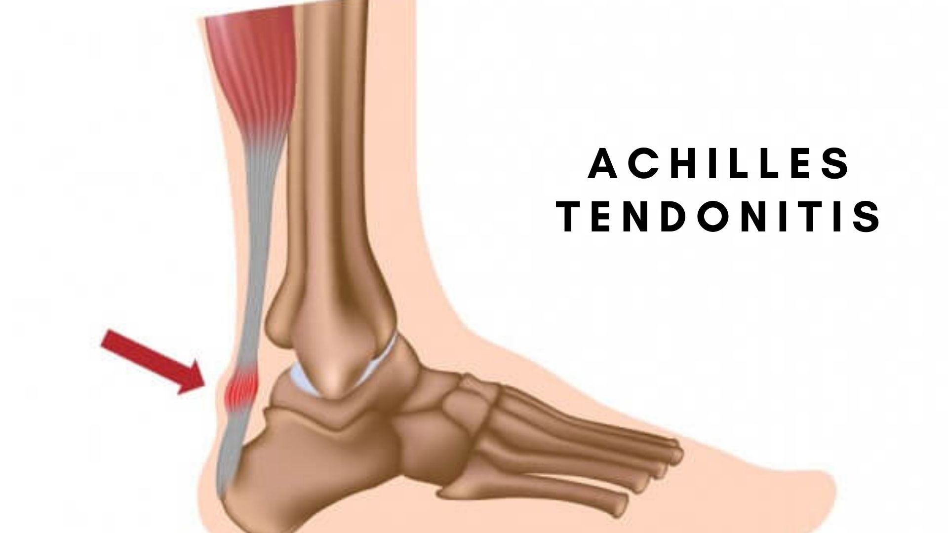 Why Your Feet Hurt When You Run? Common Foot Injuries After Running